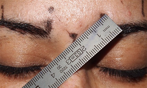 Marcación de los puntos de inyección con toxina botulínica en el tercio superior de la cara