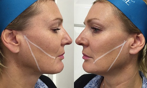 Estudio comparativo del tratamiento del tercio inferior facial con hilos de polidioxanona y mesoterapia de ácido hialurónico