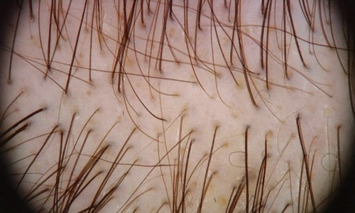 Revisión actualizada del tratamiento de la alopecia androgenética femenina
